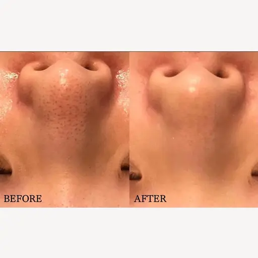 【2段階毛穴洗浄/肌診断付】アクアポアで毛穴&角質黒ずみ洗浄！