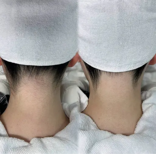 【 うなじ脱毛＋シェービング 】後ろ姿美人へ🦢🏹