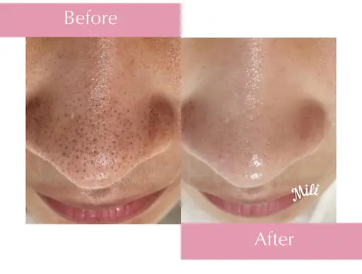 \１周年記念・10名限定/✨年末キャンペーン❄️通常価格¥16,500→¥9,800でご案内！【毛穴＋肌質改善コース】