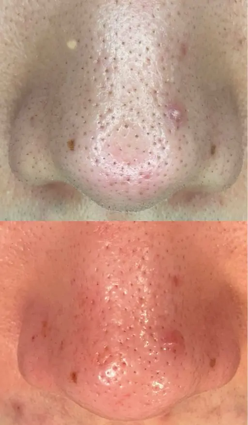 毛穴エクストラクション