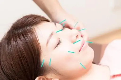 ♢美容はり60分コース♢小顔になりたい方、お肌もちもちになりたい方おすすめ❤