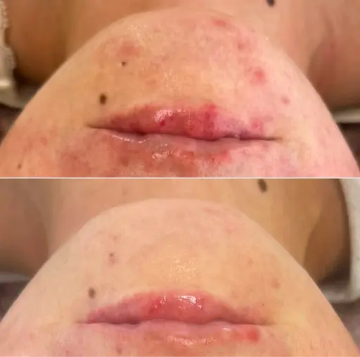 韓国同価格🇰🇷ララピール(顔首)＋水光パック 定価11,000