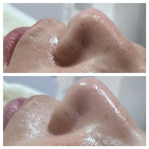 【毛穴洗浄】ハイドラフェイシャル写真モデル