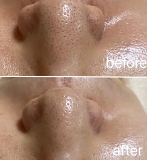 ◎ピーリング【美容液で洗うピーリング　1回コース】ハイドロビーナス