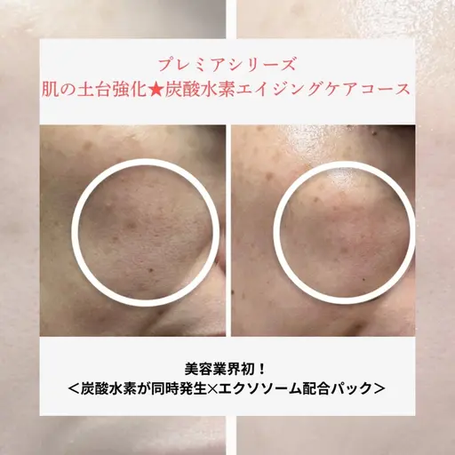 肌の土台強化★炭酸水素エイジングケアメニュー