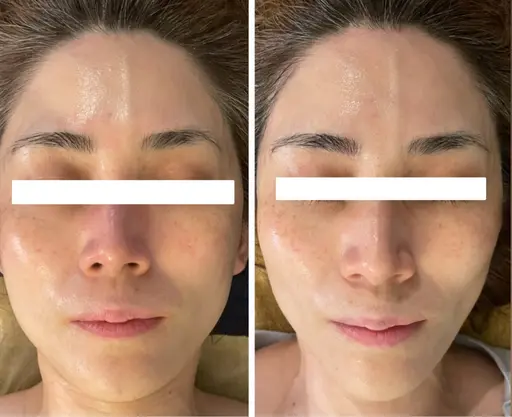 ㊗️周年記念‼️【¥33,000→¥28,600   期間中何度でも🆗】桁違いの高濃度幹細胞×テラボーラー×テラパック