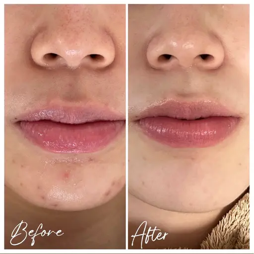 【顔◆人気No.1】剥けるハーブピーリングx鎮静パック