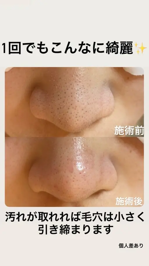 毛穴美人コース【毛穴エクストラクション】鎮静パック付きまモデル1000円価格は限定5名さま