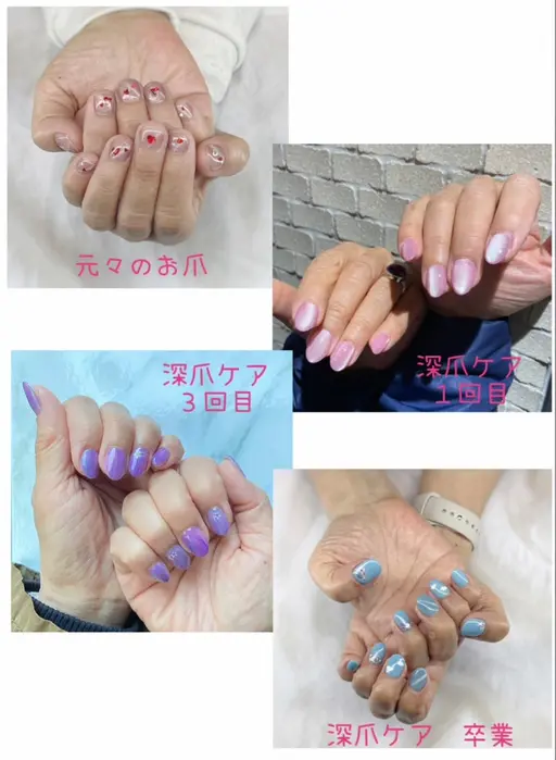 深爪ケア（ワンカラー）　モニター募集