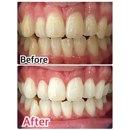 【人気No.1👑】90%の方が選ぶ🔥30分×8来店(1回あたり約4,000円)セルフホワイトニング🦷🔥