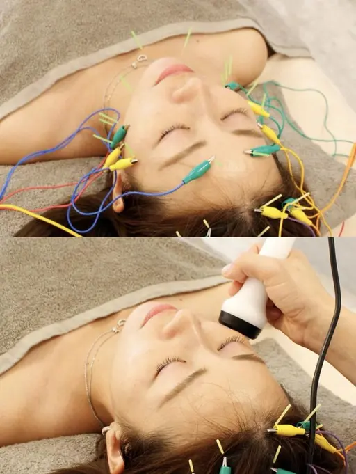 人気No2🤩【美容鍼＋強力EMS】任せて最強小顔7900円Vライン美人