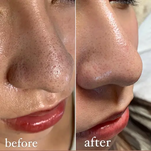 角質もスッキリ✨ツヤすべ肌に♡フェイシャルワックス脱毛👳♀️✨