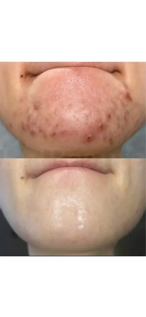 【女性専用/皮むけなし/ソフト】ニードルハーブピーリング🩵ハーブ初めての方や敏感肌の方にも✨首肩マッサージ付き🌟