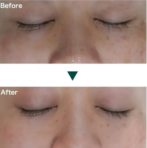 【ニキビ・ニキビ跡】強炭酸ピーリング 50分