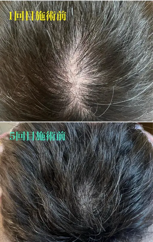 【薄毛・抜け毛・髪の毛に元気がない】育毛鍼ヘッドスパ