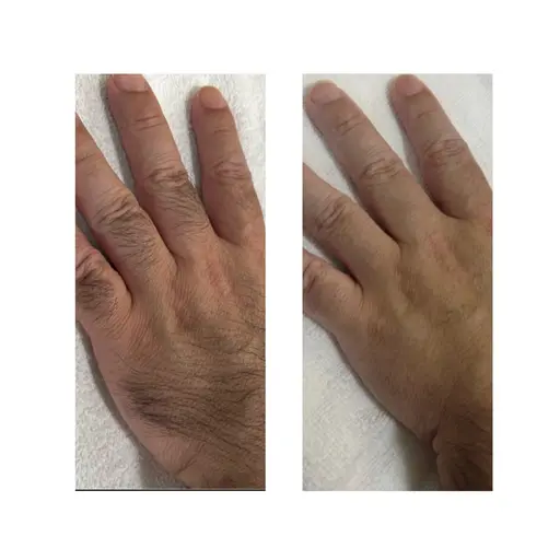 💎脱毛 手の甲・指のみ