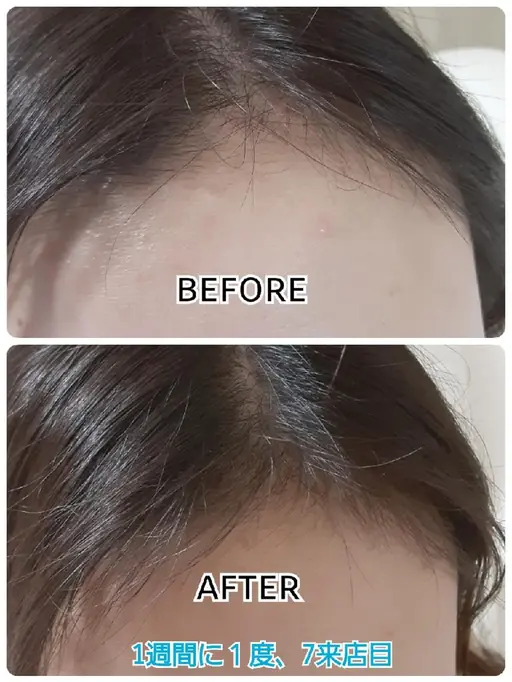 【期間限定企画】LEDスカルプモニター価格✨20照射(10来店！)頭皮のお写真🆗週一回程度来店できる方限定でございます