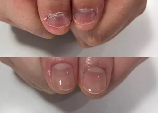 自爪で深爪矯正【噛み、むしりで爪が短くなった方】