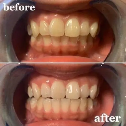 ｡:*🦷初回の方限定🦷✧︎*。15分セルフホワイトニング🐻💕20代の女性ホワイトニングお試しコース🌈🤍