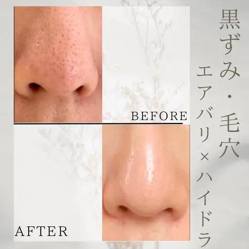 モニター価格📷【期間限定】≪鼻のみ👃≫毛穴洗浄(ハイドラ👃)＋💎温感スキンインフュージョン🚹男性も◎
