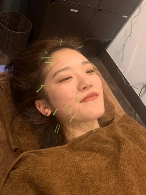 ミニモ限定⭐️顔のみ美容鍼⭐️⭐️【U24学割】口コミ❣️🌟1日5名限定⭐️