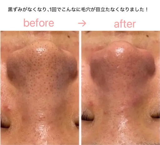 毛穴を目立たなく！ピーリング＆ハイドラ洗浄×世界特許ヒト幹細胞を使用するエレクトロポレーションで「加工いらずの艶肌」へ