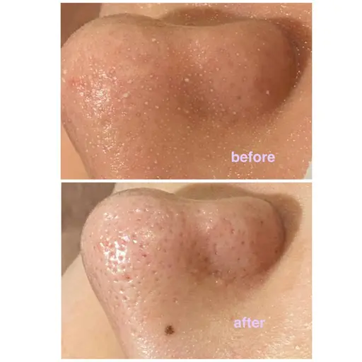 【小鼻の黒ずみやゴワつきが気になる人】毛穴洗浄ハイドラフェイシャル【2回目まで同価格】