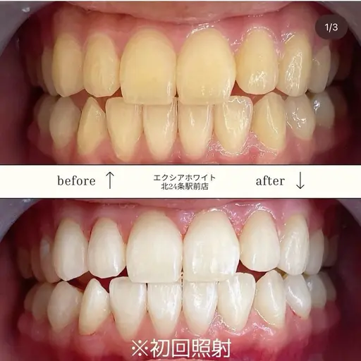 *⋆⸜ オープン記念⸝⋆*‬セルフホワイトニング¥3980→¥500‼️