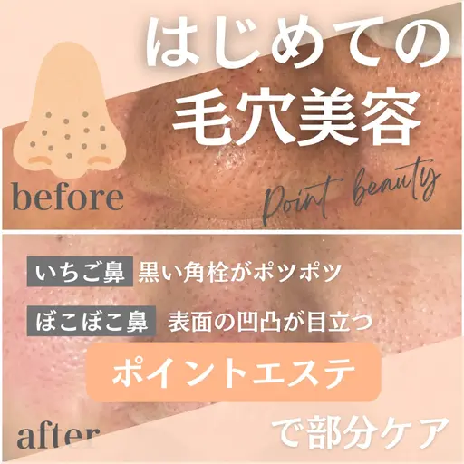 エステ初心者にオススメの鼻の毛穴集中エステ✨