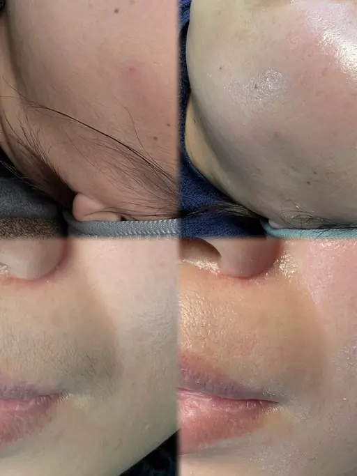 フェイシャル韓国美肌wax（全顔）（1日1名限定の為お日にちのご変更をお願いする場合が御座います）