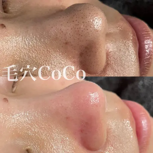 毛穴の黒ずみ撃退！毛穴エクストラクションプロ