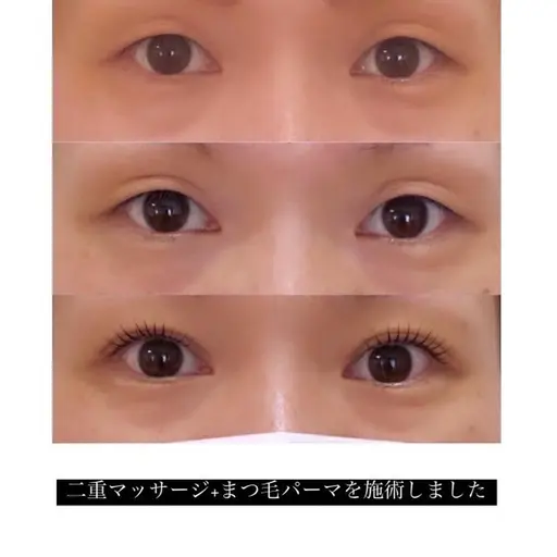 切らずに二重✨ダブルアイリフト