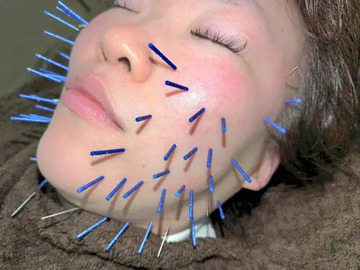 写真モニターOKの方!癒着剥がし美容鍼・小顔矯正・最後顔から肩のマッサージ付【たるみ・ムクミ】に◎