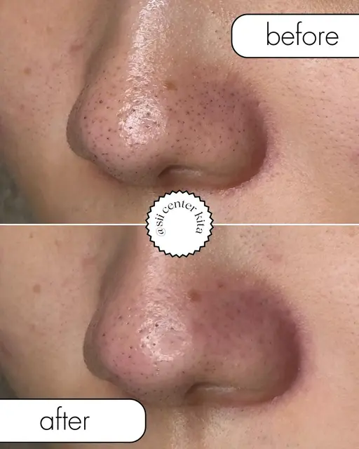 最新毛穴洗浄🫧美容成分を含んだトルネード水流の最新ピーリング💫黒ずみや開き毛穴、お肌のゴワつきにも◉炭酸ガスパック付