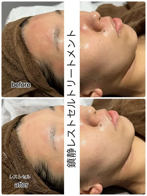 【圧倒的透明感】美肌鎮静トリートメント🐹✨14300→13000