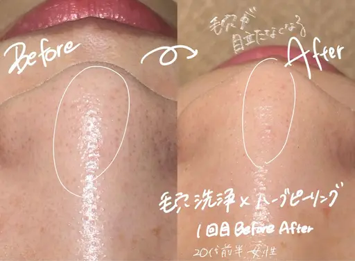 【人気NO２】全顔剥離なしハーブピーリング+毛穴洗浄鼻のみ　50分