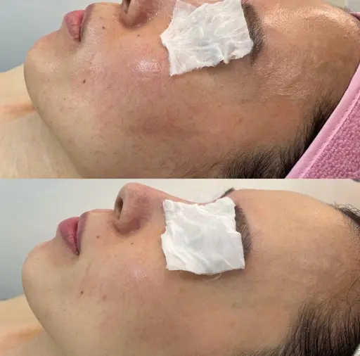 🌿トゲなしオーガニックハーブピーリング敏感肌もOK｜剥けない・痛くない・当日メイク可✨