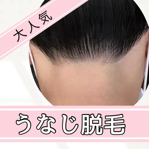 』うなじ脱毛 シェービング込み ￥3300円