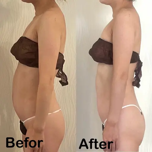 27000→18000【最新高周波カッピング】ぽっこりお腹・浮き輪肉・くびれにアプローチ！！《1部位✖️3回》