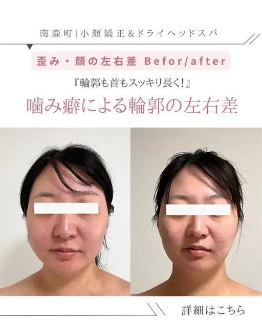 🌿 30代限定 3ヶ月間（6回来店条件）90分【エラ張り/食いしばり解消小顔ヘッドスパ】