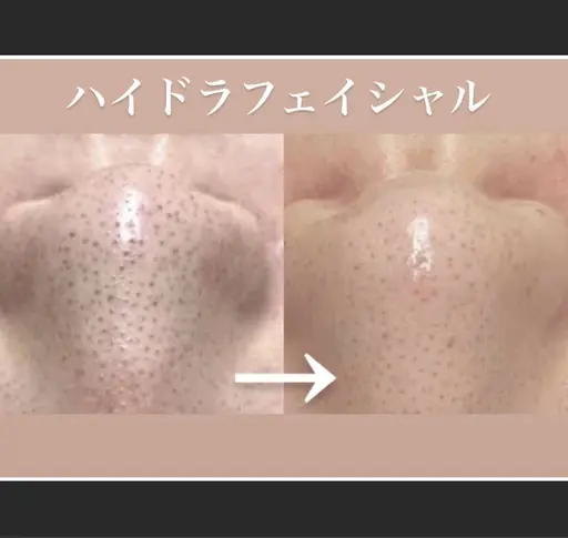 【口コミ投稿限定】毛穴洗浄コース　黒ずみ/いちご鼻に👃濃密ホワイトハニーで美肌へ♪