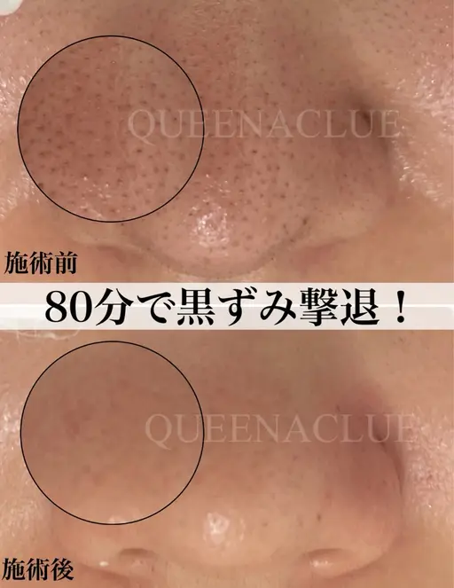 【12月10日12時30分15時限定】毛穴改善ケア￥8800長年のいちご鼻から卒業/毛穴のザラつき/黒ずみ/毛穴の開き