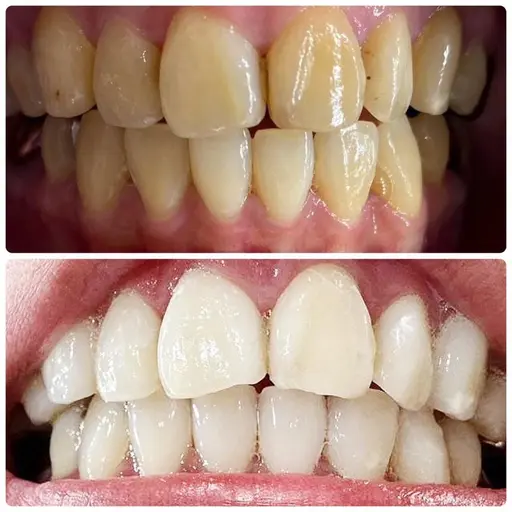 お試しセルフホワイトニング1照射¥3500