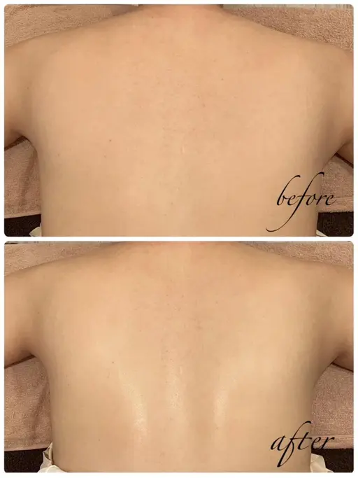 ⭐️ミニモ限定　背中オイルマッサージ付き⭐️脱離なし★背中ピーリング＆美白パック　背面美人コース50分　¥5500