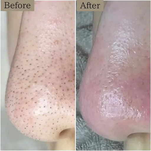 《鼻のみ》【黒ずみ毛穴ケア・毛穴洗浄】黒ずみに悩まない毛穴ケア＆肌づくり◉初回8500円