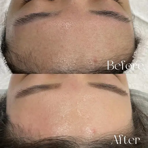 【⭐️フェイシャルワックス脱毛⭐️】WAXXXX ワックストリプルエックス