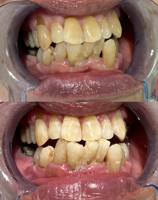 トーンアップセルフホワイトニング4回コース(20×2回)