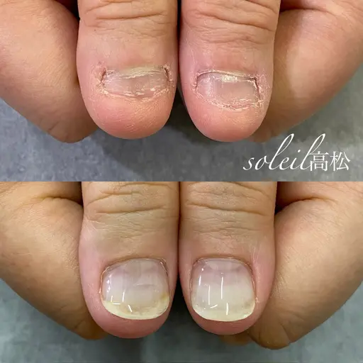 【初回】本格深爪矯正 ホームケア付き