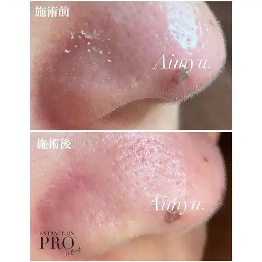 新年特別企画🎁人気No.1👑【毛穴美人コース】🫧70分を特別価格で💓