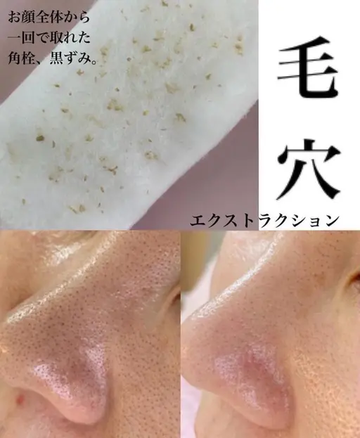 【毛穴洗浄】毛穴エクストラクション